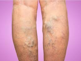 Homeopathy Medicine for Varicose Veins